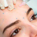 Cuando el botox empieza a funcionar?