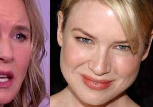 Botox ¿quién lo hace?