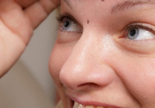 Cuando el botox golpea un nervio?
