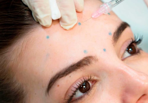 Cuando el botox empieza a funcionar?